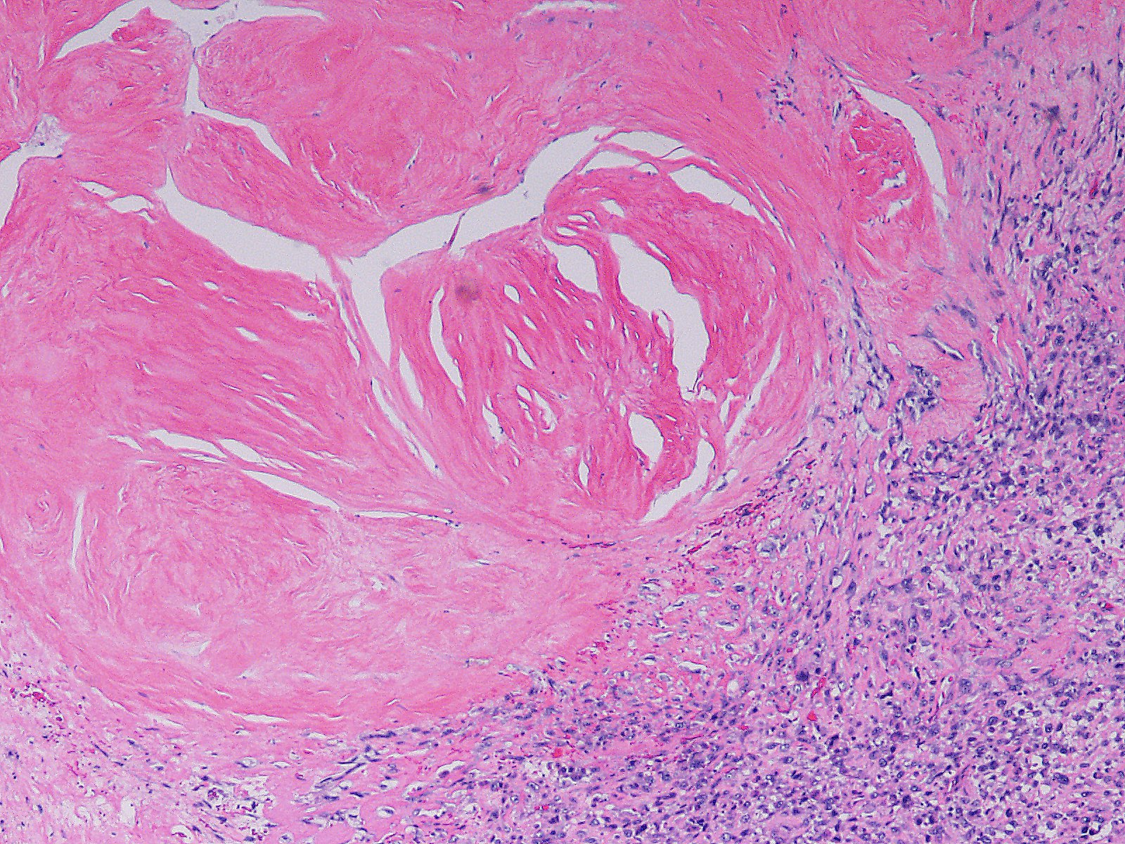 Week 619: Case 2 | Johns Hopkins Surgical Pathology Unknown Conference