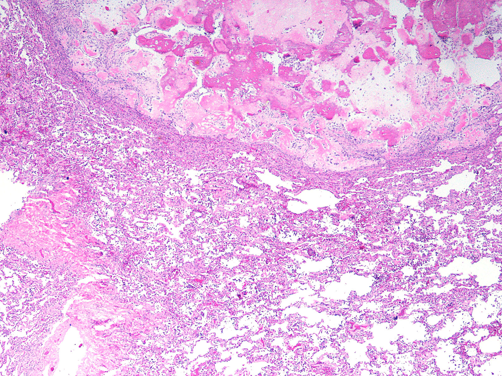 Week 644: Case 2 | Johns Hopkins Surgical Pathology Unknown Conference