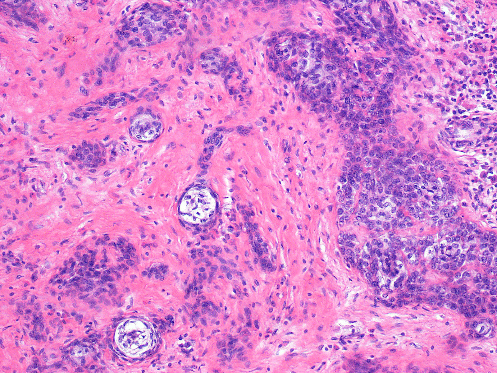 Week 648: Case 2 | Johns Hopkins Surgical Pathology Unknown Conference