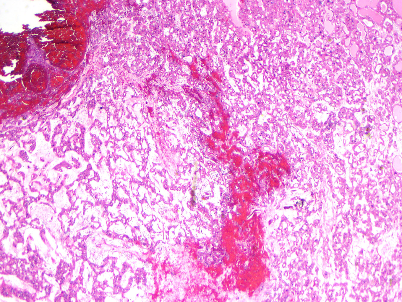Week 654 Case 2 Johns Hopkins Surgical Pathology Unknown Conference week-654-case-2-johns-hopkins-surgical-pathology-unknown-conference