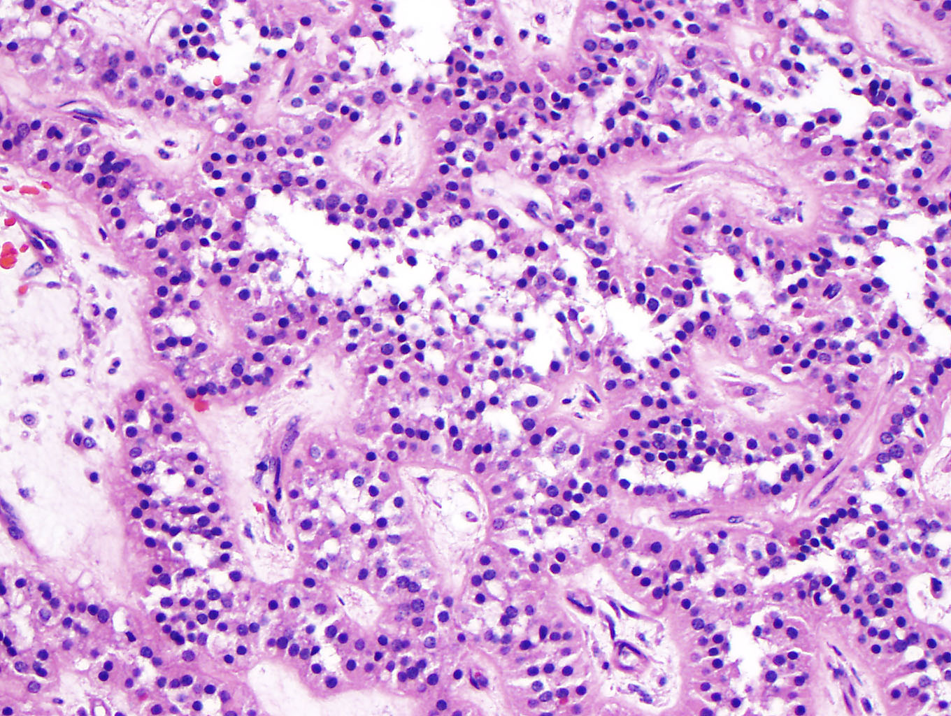 Week 653: Case 1 | Johns Hopkins Surgical Pathology Unknown Conference