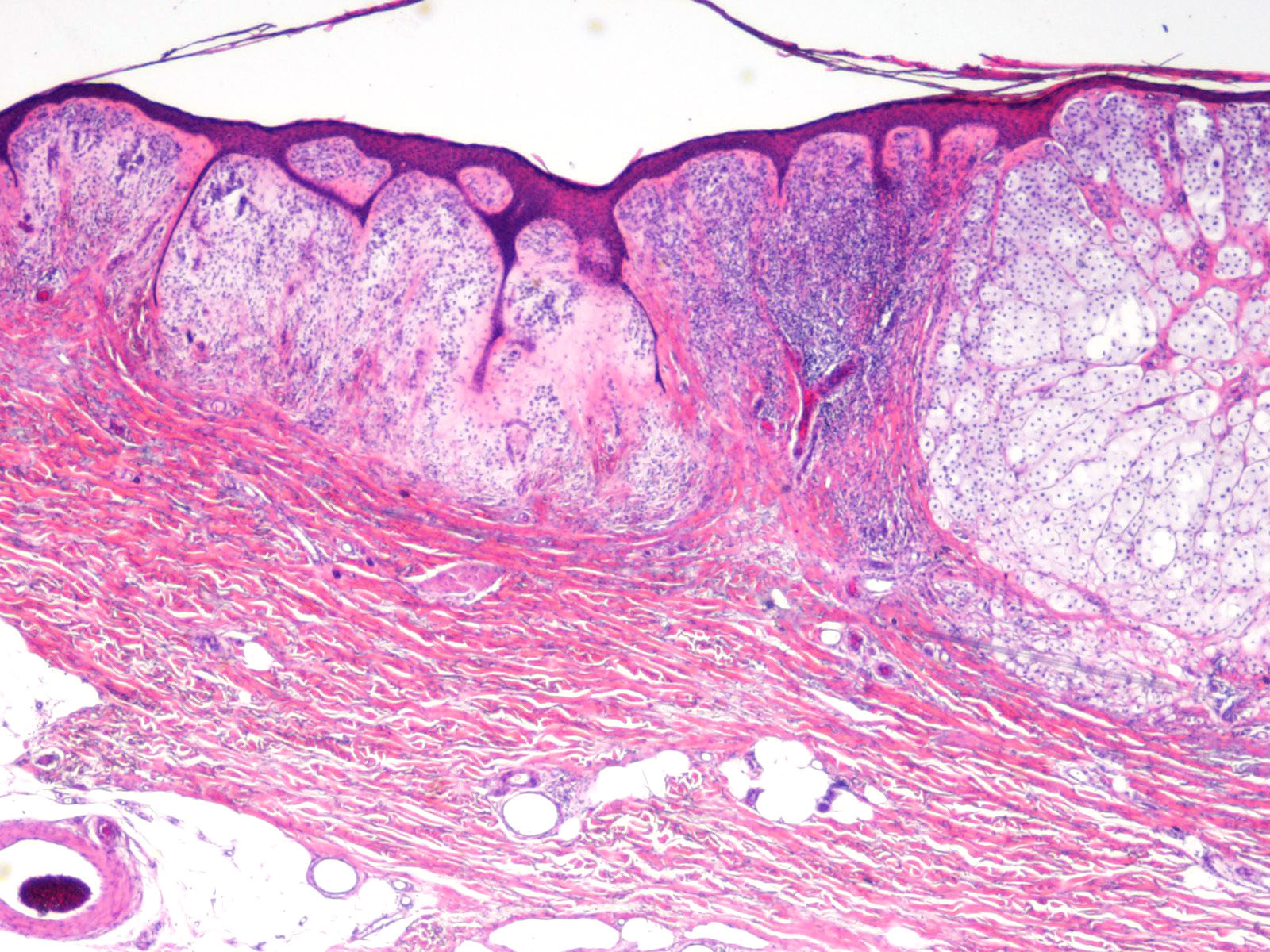 Week 664: Case 3 | Johns Hopkins Surgical Pathology Unknown Conference