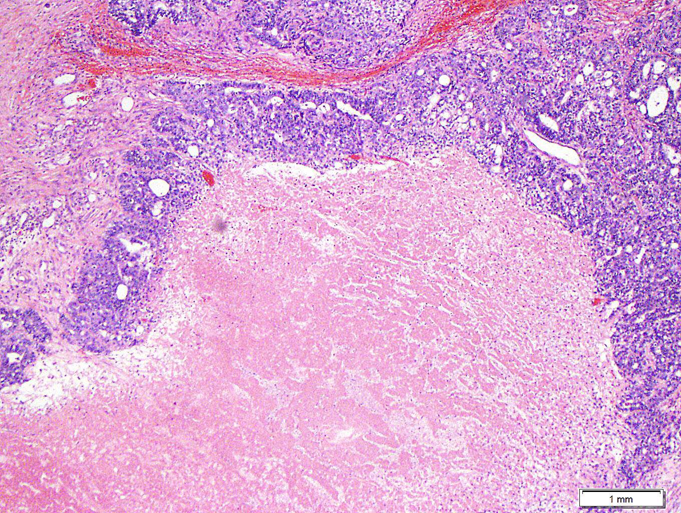 Week 689: Case 3 | Johns Hopkins Surgical Pathology Unknown Conference