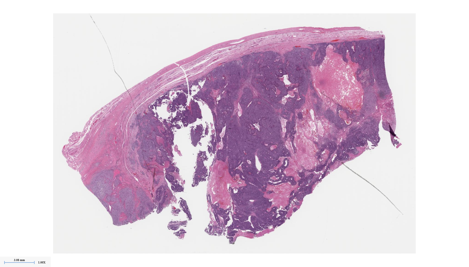 Week Case Johns Hopkins Surgical Pathology Unknown Conference