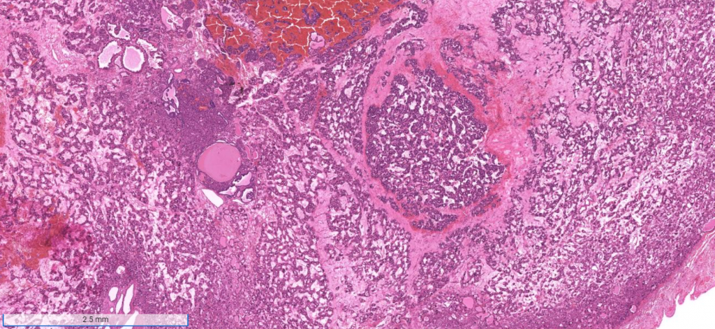 Week 762 Case 1 Johns Hopkins Surgical Pathology Unknown Conference week-762-case-1-johns-hopkins-surgical-pathology-unknown-conference