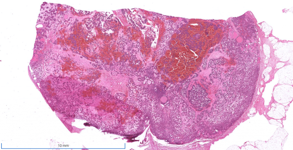 Week 762 Case 1 Johns Hopkins Surgical Pathology Unknown Conference week-762-case-1-johns-hopkins-surgical-pathology-unknown-conference