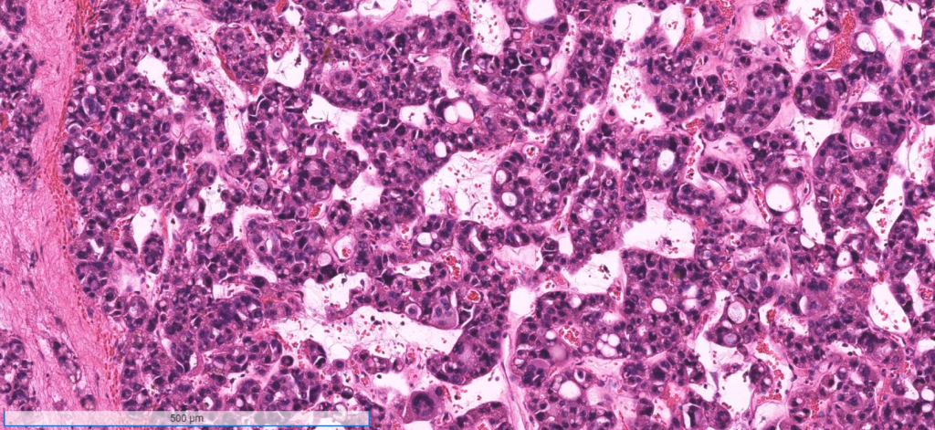 week-762-case-1-johns-hopkins-surgical-pathology-unknown-conference