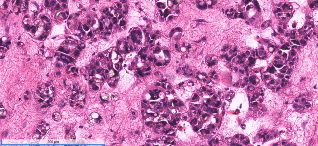 Week 762 Case 1 Johns Hopkins Surgical Pathology Unknown Conference week-762-case-1-johns-hopkins-surgical-pathology-unknown-conference