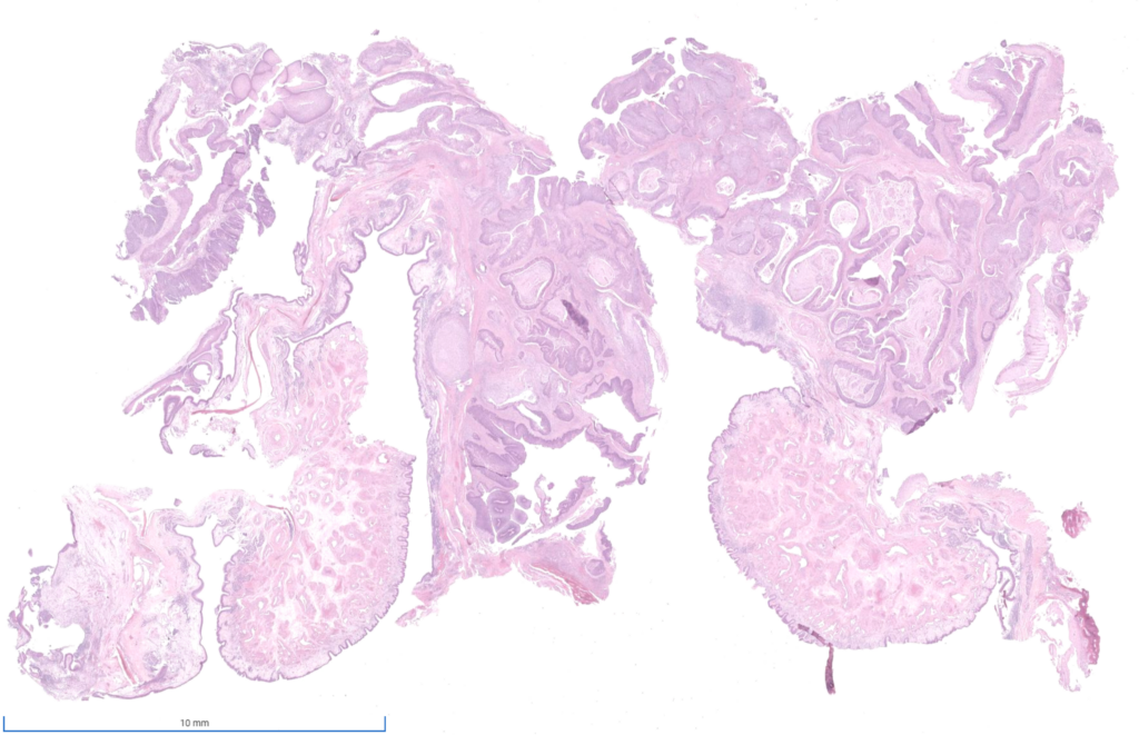 Week 774: Case 2 | Johns Hopkins Surgical Pathology Unknown Conference