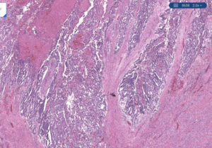 Week 808: Case 2 | Johns Hopkins Surgical Pathology Unknown Conference